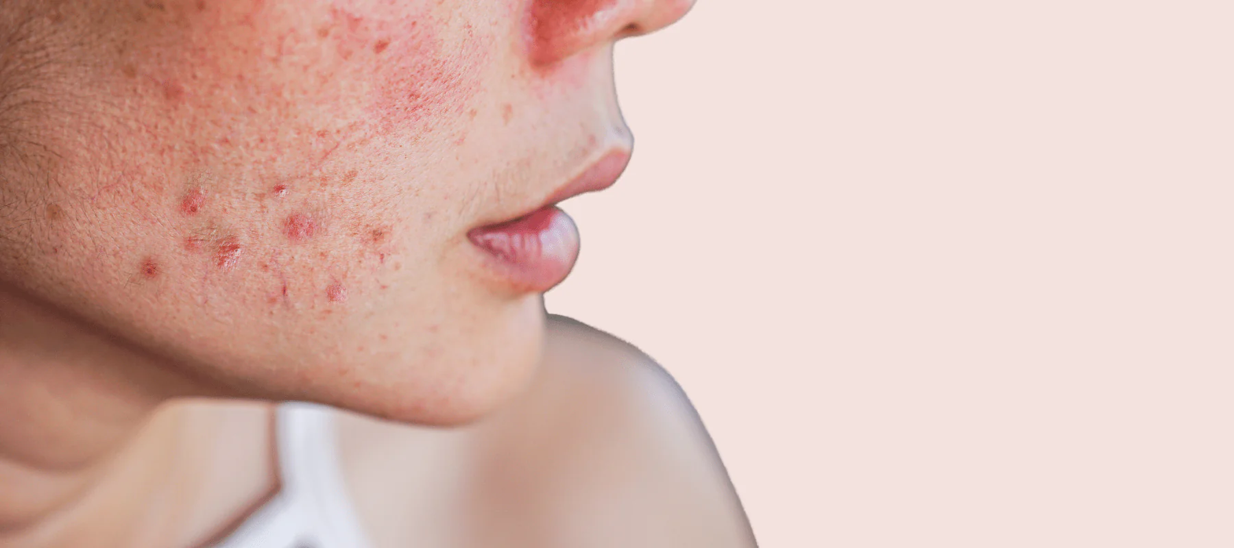 Acne Treatment